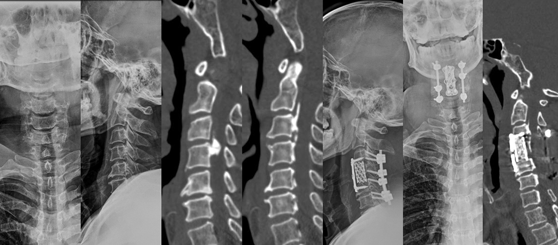 頸椎骨折前后路減壓復位內固定術（男，52歲）.jpg