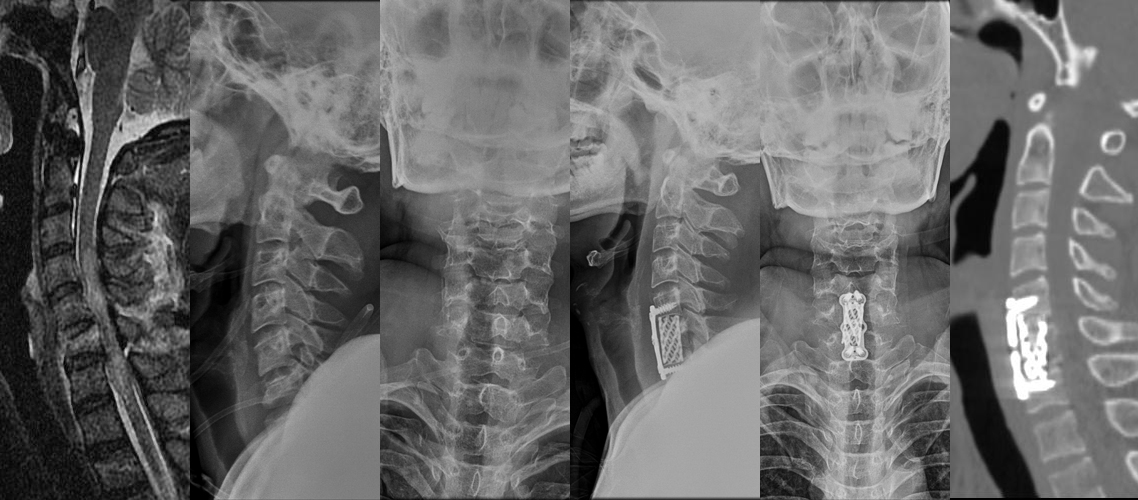 頸椎骨折前路復位固定術（男，36歲）.jpg