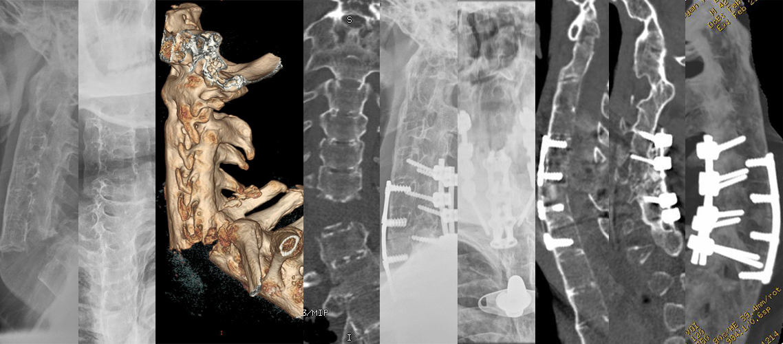 強制性脊柱炎合并頸椎骨折前后路復位內固定術（男，42歲）.jpg